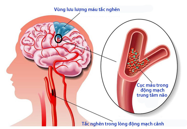 Cơn thiếu máu não thoáng qua (TIA) - Hình ảnh minh họa